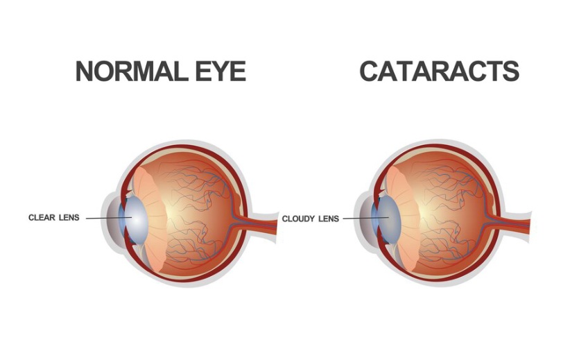 Cataracts