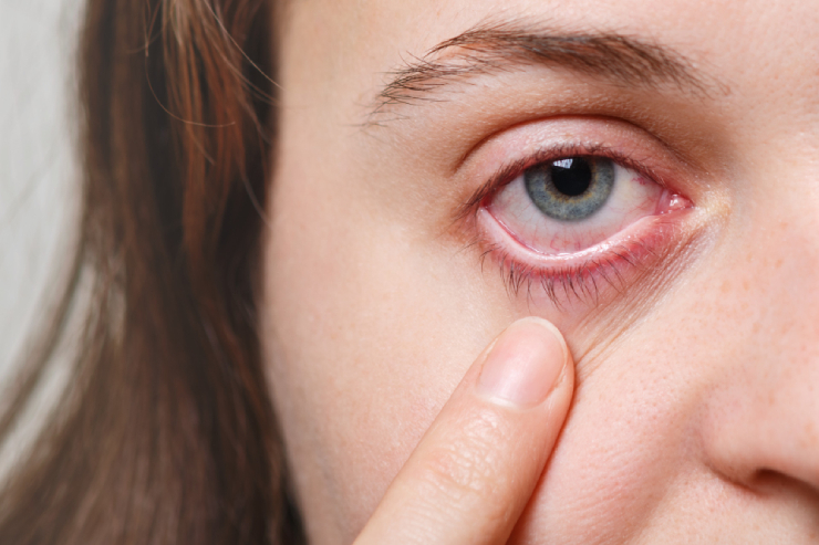 Dry Eye Syndrome,