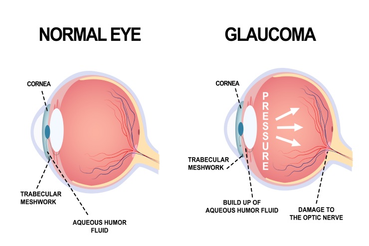 Glaucome