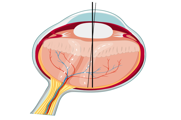 retinal detachment